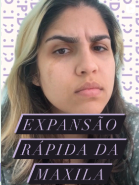 Print do Instagram da Dra. Mari sobre publicação sobre expansão da maxila
